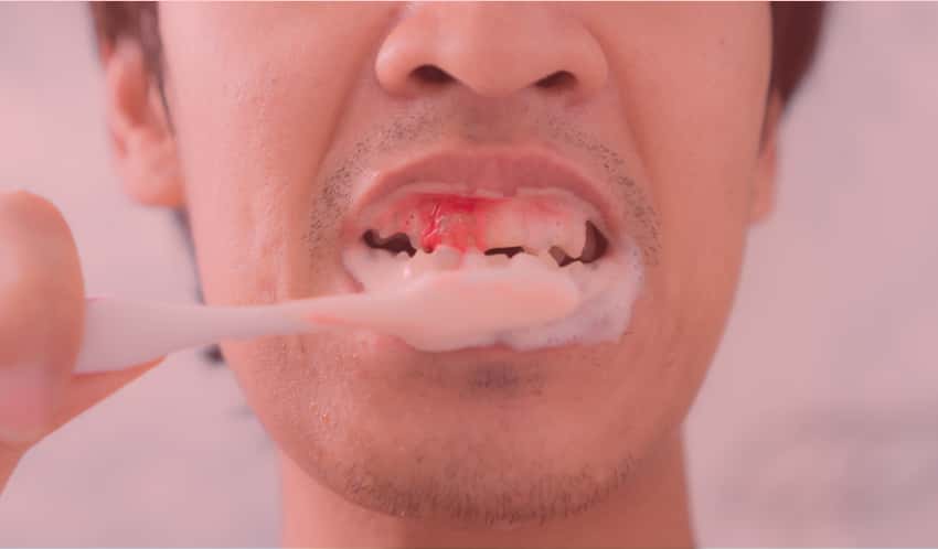 Mann putzt sich die Zähne, am oberen Zahnfleischrand ist frisches Blut zu sehen